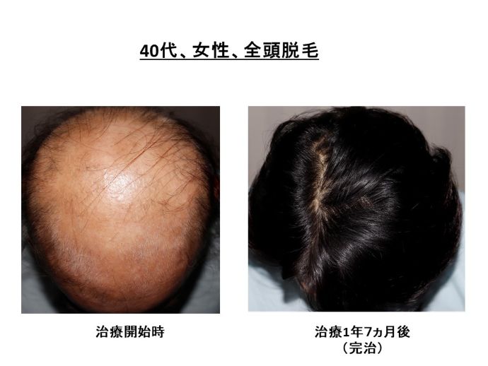 円形脱毛症　病院